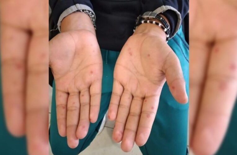 Detectan brote de virus coxsackie en San Martín Texmelucan, Puebla