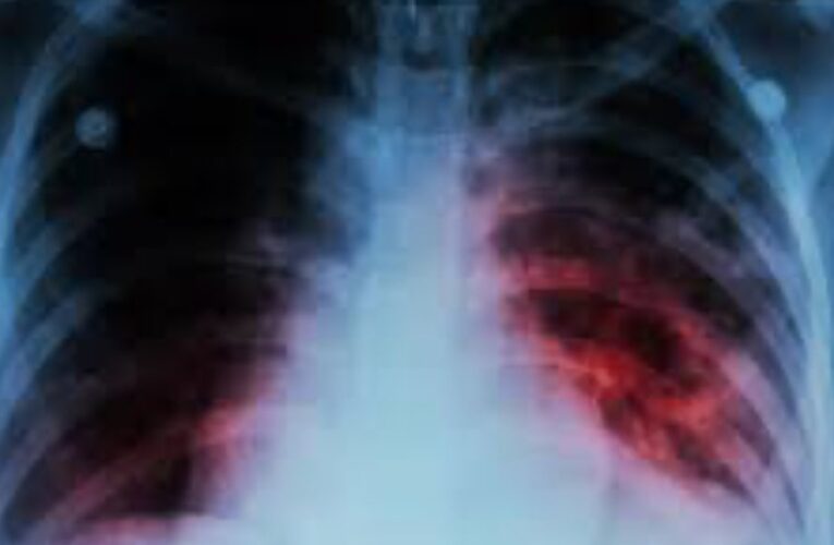 Aumento de casos de tuberculosis en México: la segunda enfermedad más prevalente después de la influenza
